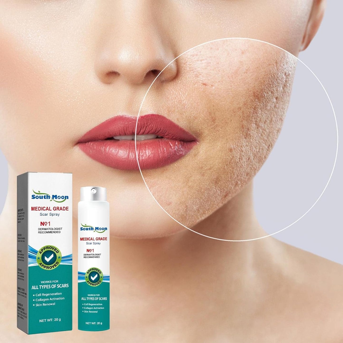 Advanced Scar Spray For All Types of Scars - For example Acne Scars, Surgical Scars and Stretch Marks