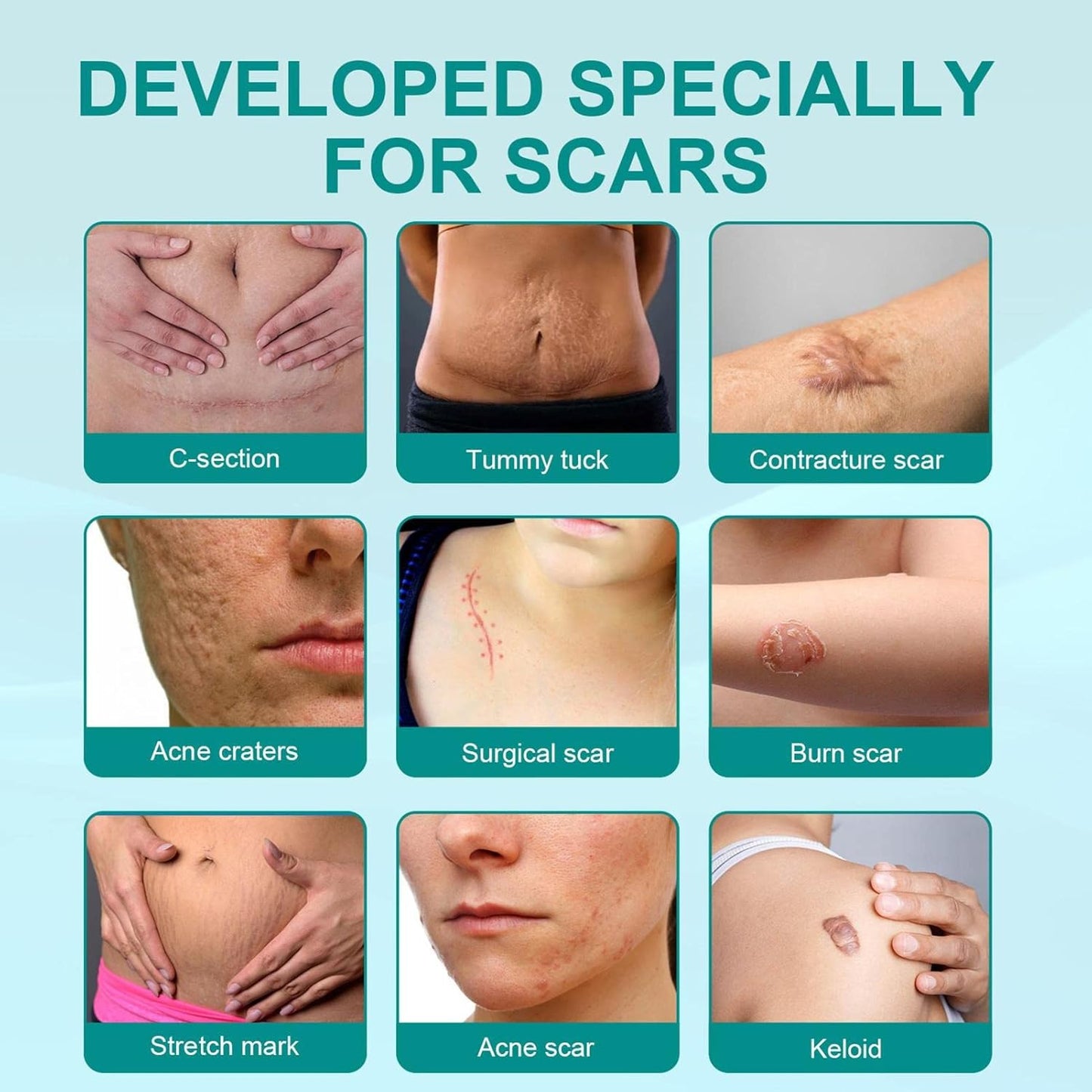 Advanced Scar Spray For All Types of Scars - For example Acne Scars, Surgical Scars and Stretch Marks
