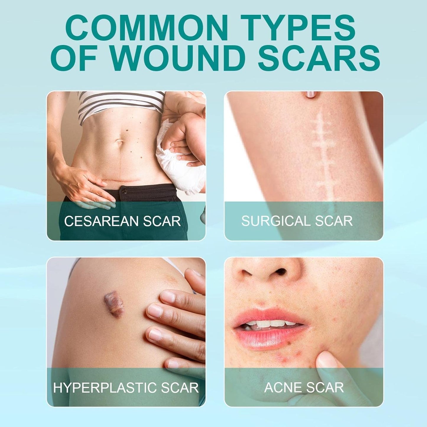 Advanced Scar Spray For All Types of Scars - For example Acne Scars, Surgical Scars and Stretch Marks