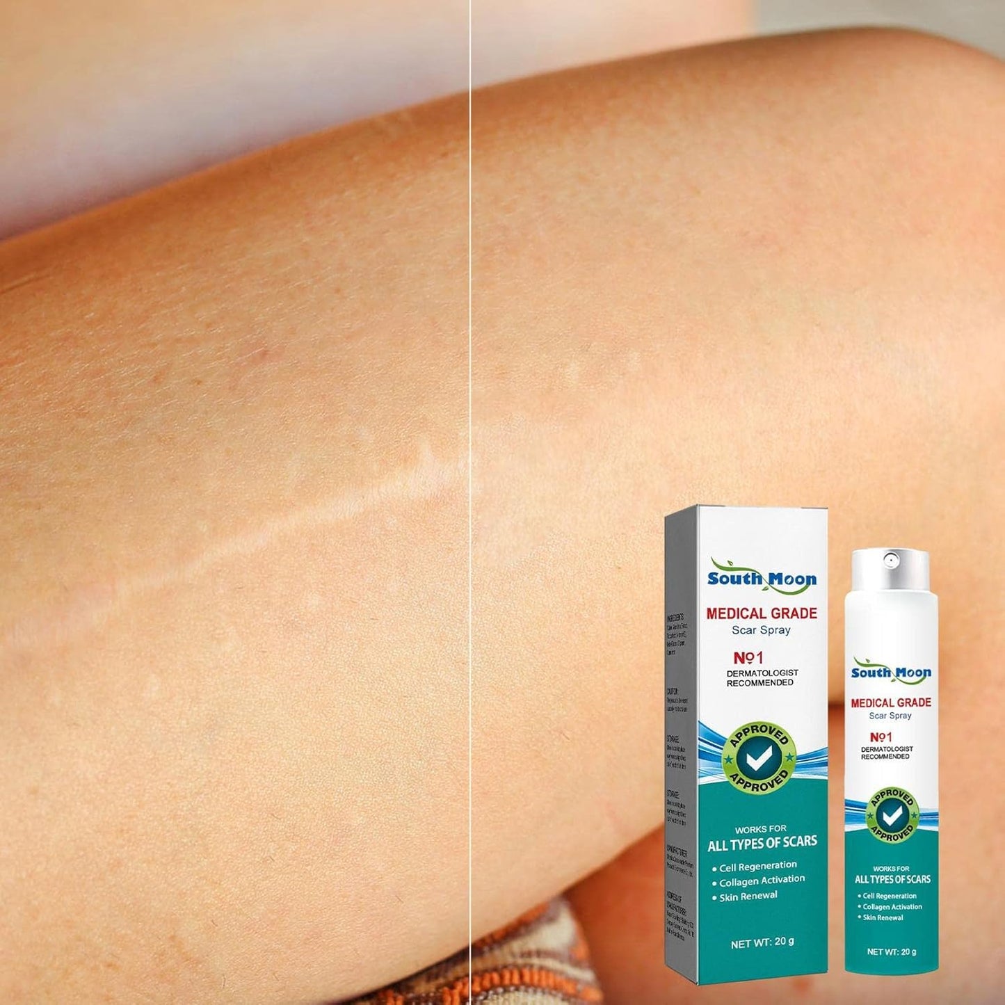 Advanced Scar Spray For All Types of Scars - For example Acne Scars, Surgical Scars and Stretch Marks