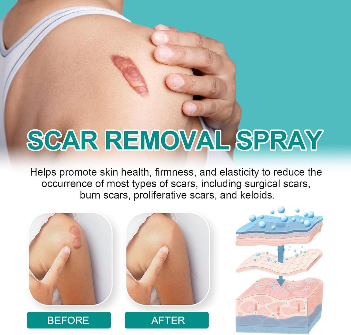 Advanced Scar Spray For All Types of Scars - For example Acne Scars, Surgical Scars and Stretch Marks
