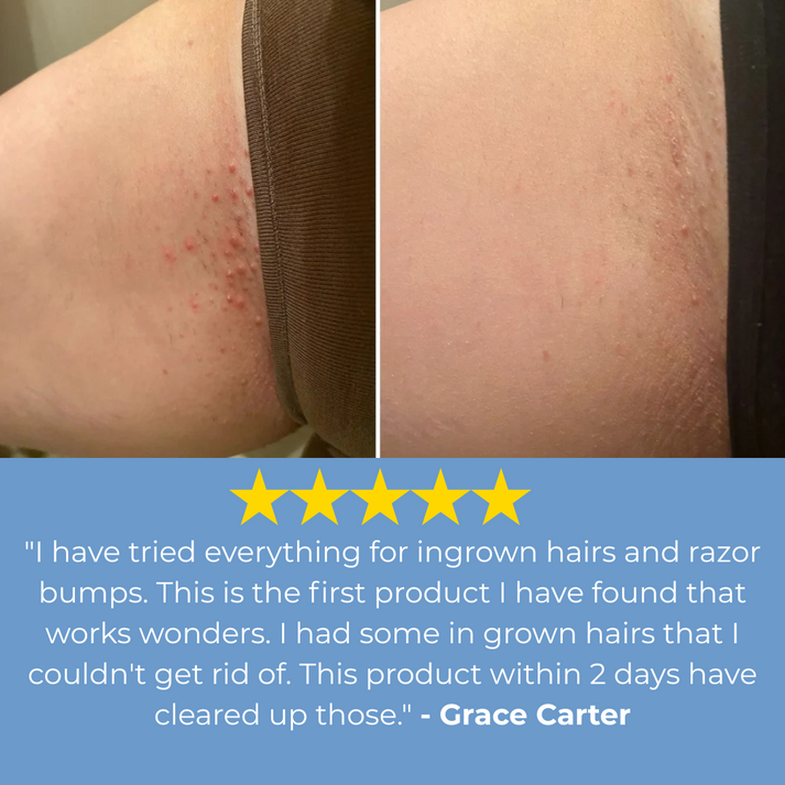 Women's Smoothing Serum For Ingrown Hairs, Razor Bumps And Redness