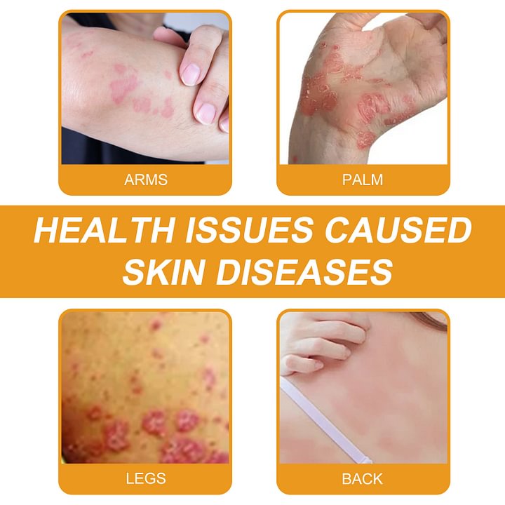 💥Bee Venom Multi-Symptom Skin Cream (👨‍⚕CDA RECOMMENDS)