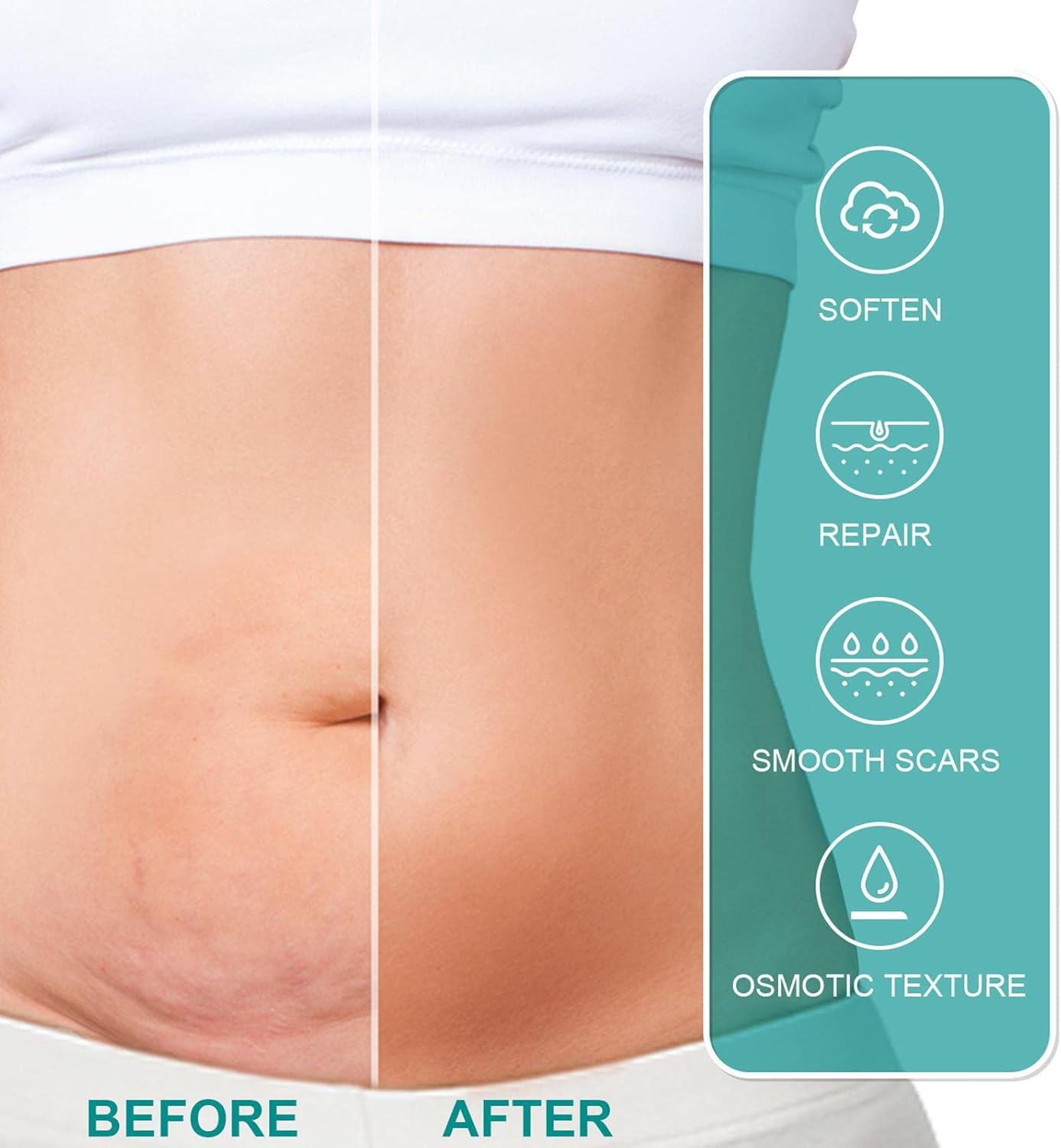 Advanced Scar Spray For All Types of Scars - For example Acne Scars, Surgical Scars and Stretch Marks